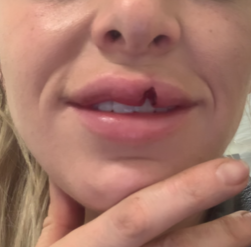Woman with injured lip